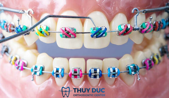 Tìm hiểu 15 loại khí cụ phổ biến trong chỉnh nha