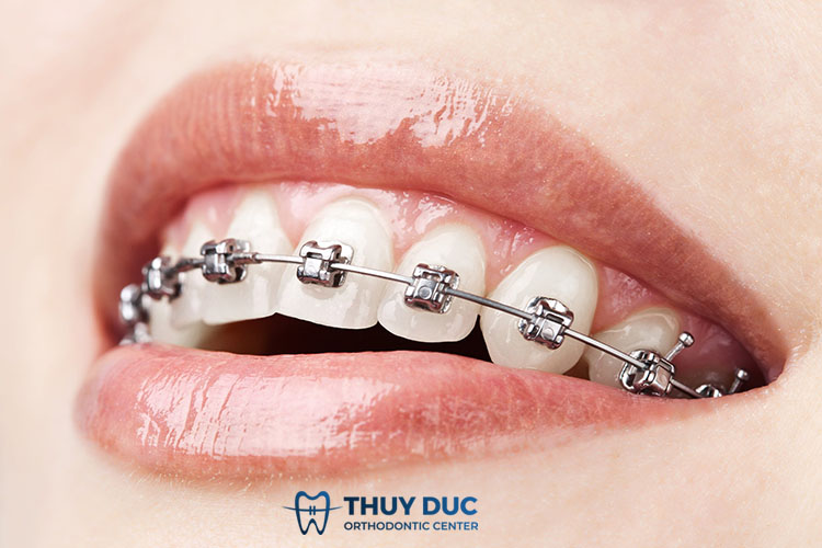 1. Niềng răng mắc cài kim loại là gì? 1 1. Niềng răng mắc cài kim loại là gì? 1