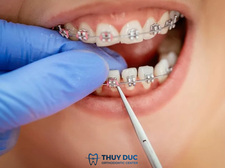 Niềng răng mắc cài kim loại thường (truyền thống) 1 Niềng răng mắc cài kim loại thường (truyền thống) 1