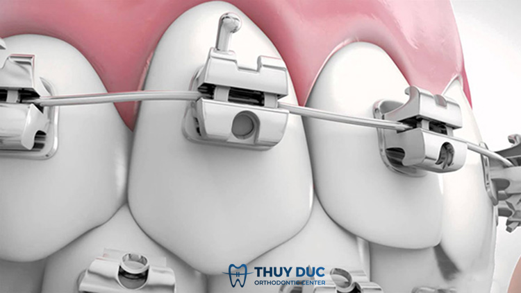 Niềng răng mắc cài kim loại tự động (tự đóng/tự khóa) 1 Niềng răng mắc cài kim loại tự động (tự đóng/tự khóa) 1