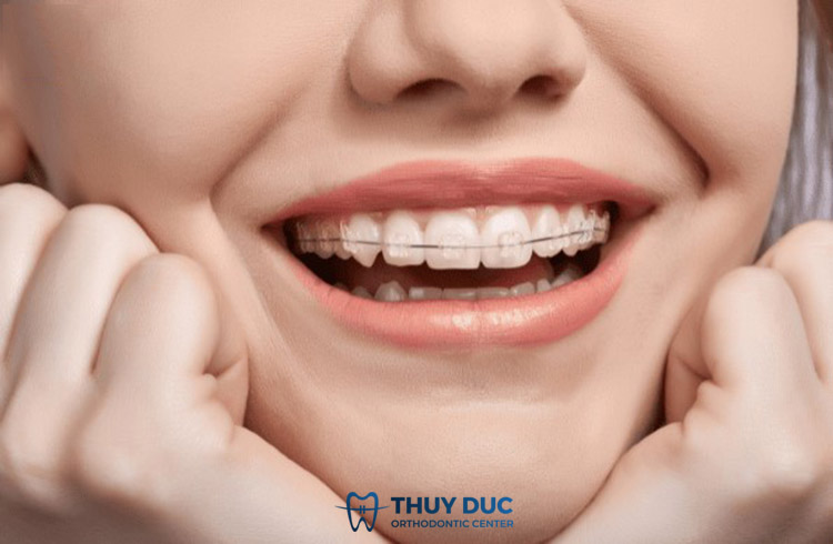 Niềng răng mắc cài sứ 1