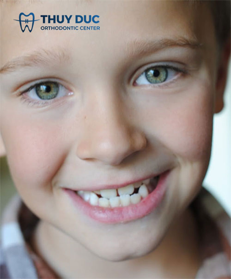 3. Tác động khớp cắn ngược đến trẻ nhỏ 1