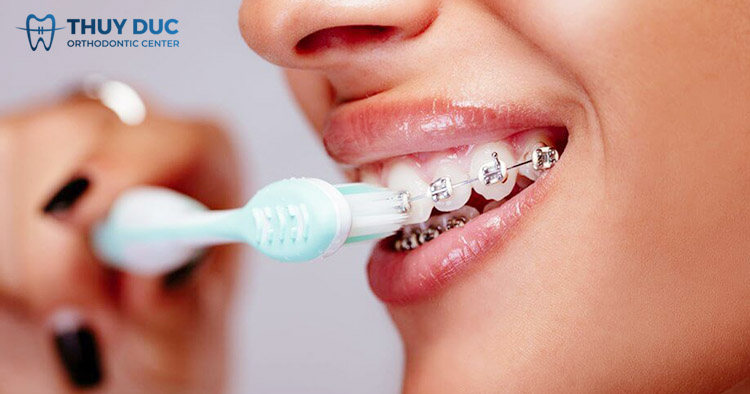 Chăm sóc răng miệng đúng cách khi niềng răng, chỉnh nha 1 Chăm sóc răng miệng đúng cách khi niềng răng, chỉnh nha 1